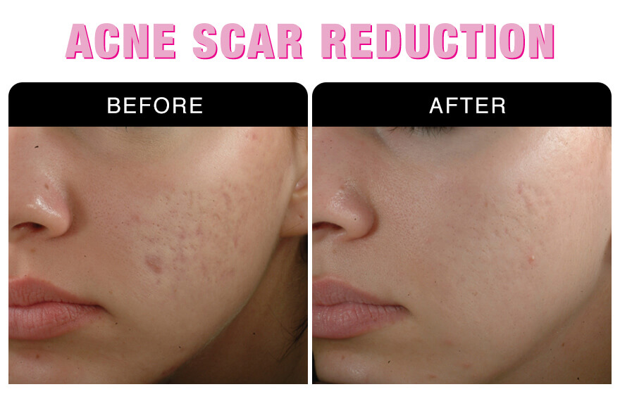 Acne Scar Reduction
