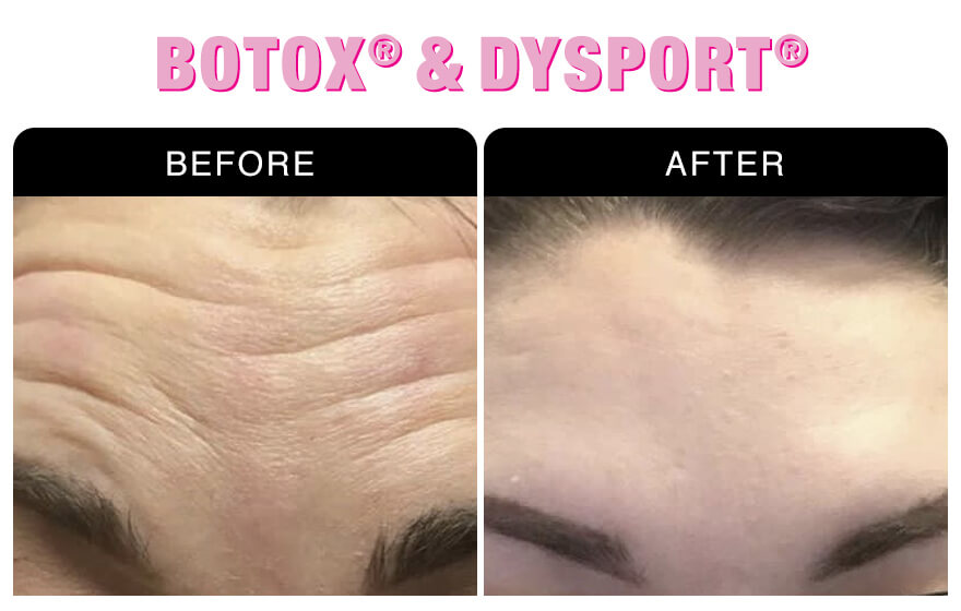 Botox & Dysport