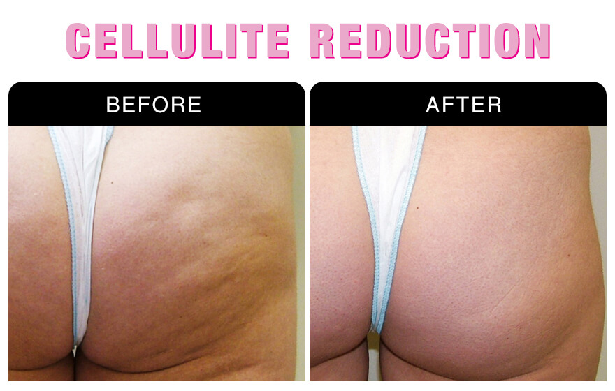 Cellulite Reduction