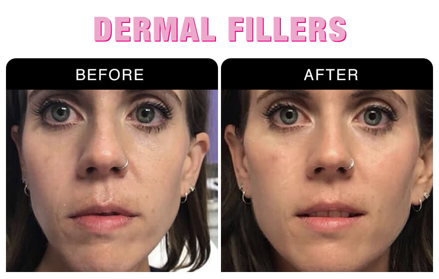 Dermal Fillers