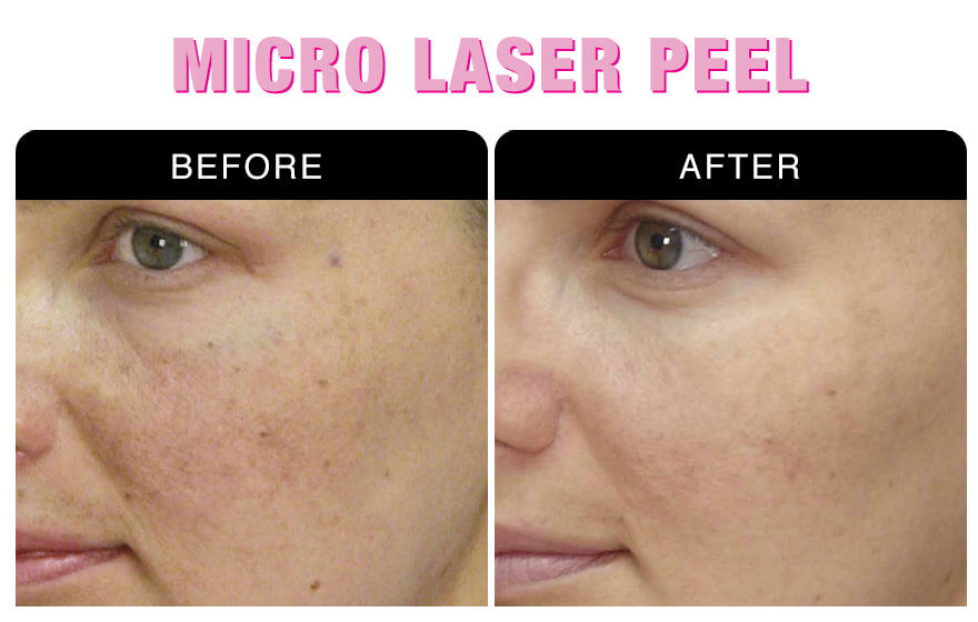 Micro Laser Peel
