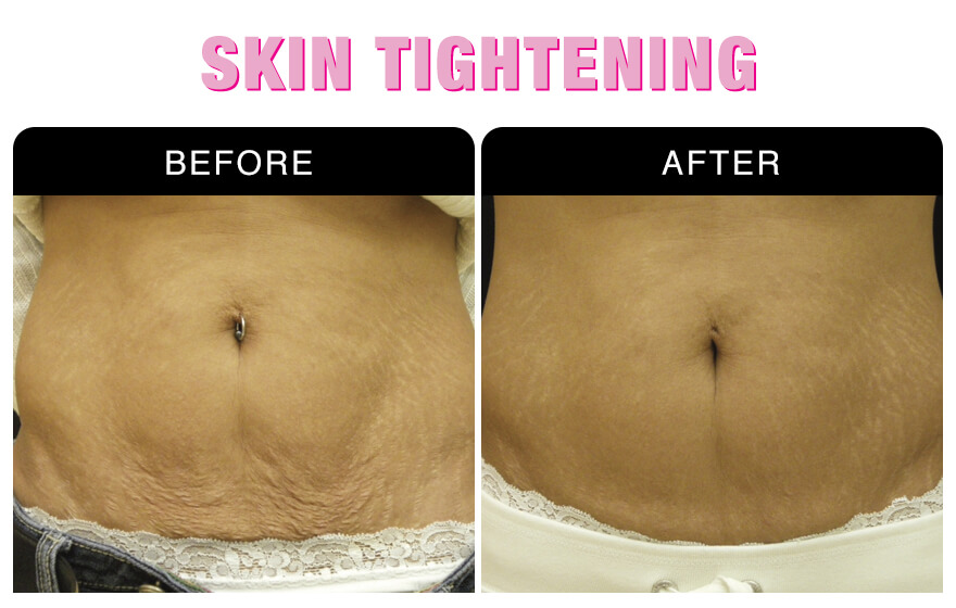 Skin Tightening