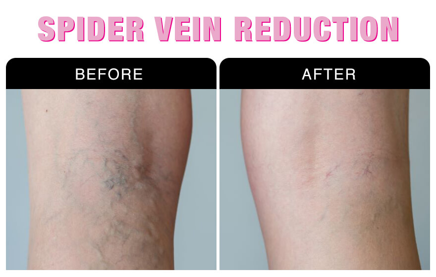 Spider Vein Reduction