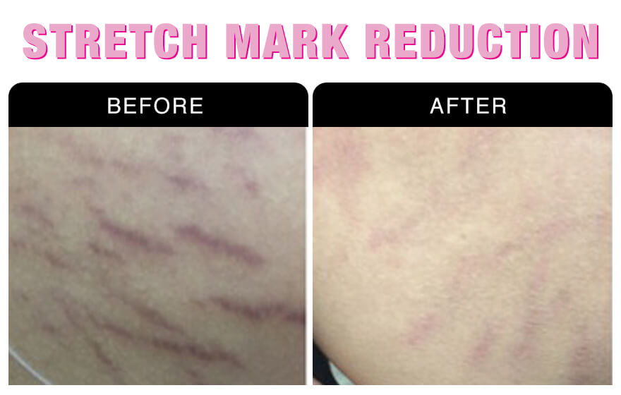 Stretch Mark Reduction