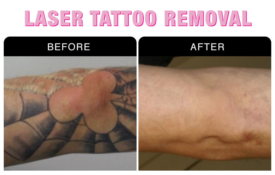 Laser Tattoo Removal