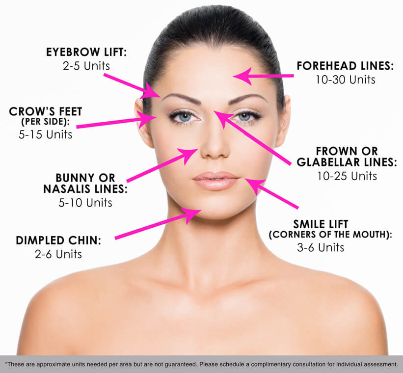 https://newmedspa.mystaging.info/wp-content/uploads/botox-face-diagram.jpg